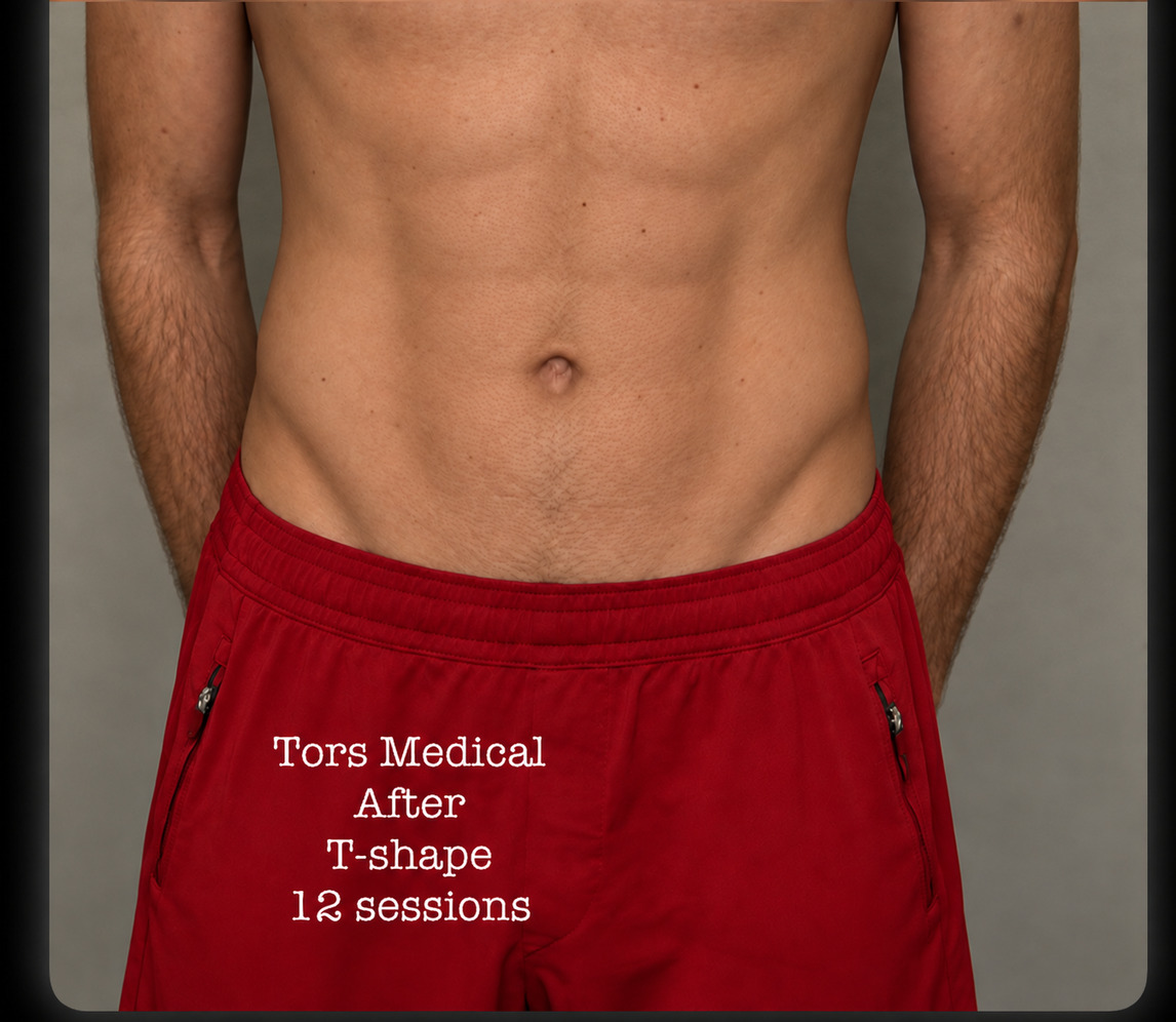 Abdomen after T-Shape 2 treatment series