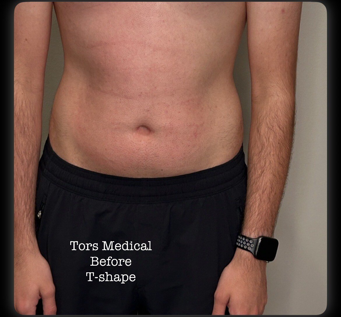Abdomen before T-Shape 2 treatment series