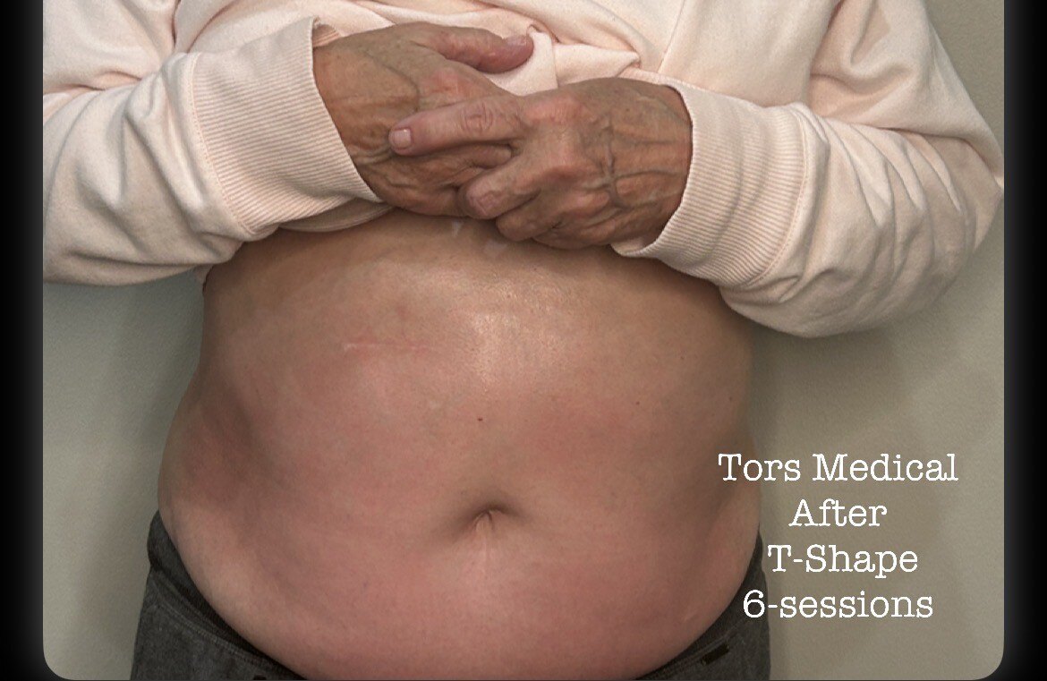 Abdomen after T-Shape 2 treatment plan
