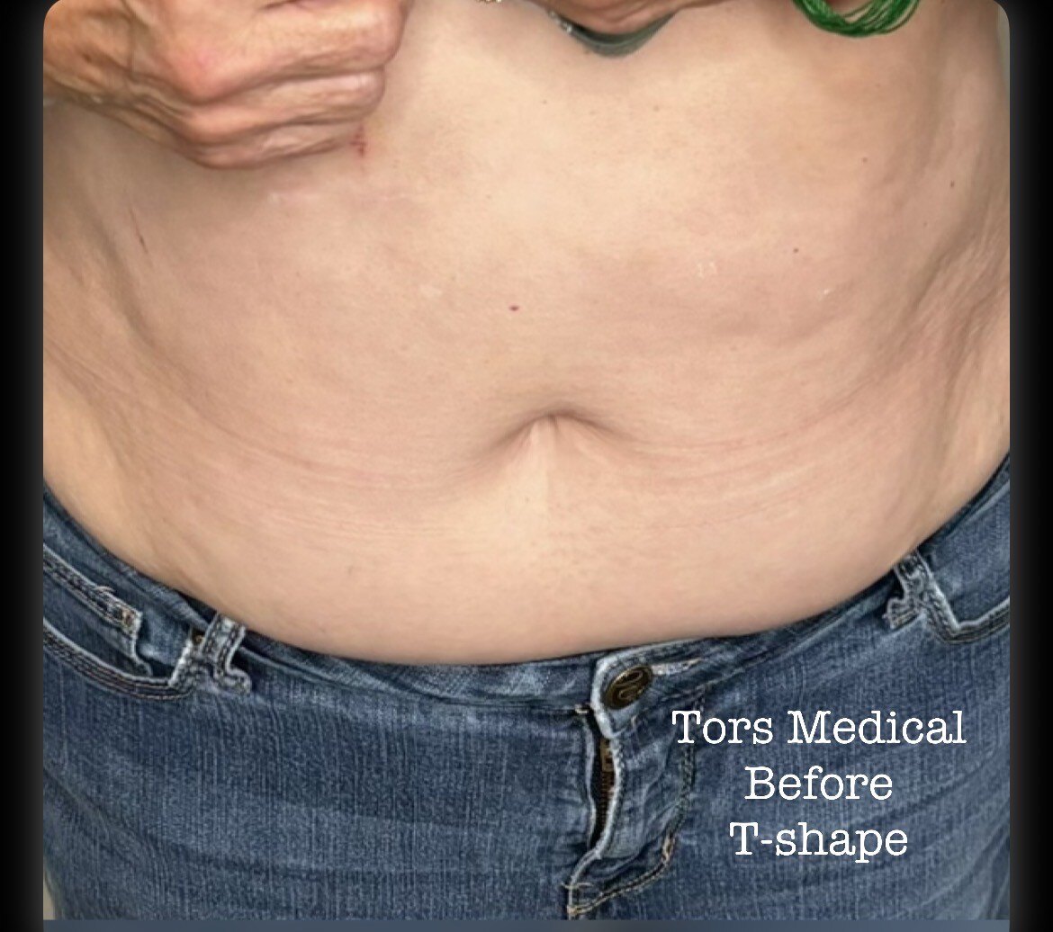Abdomen before T-Shape 2 treatment plan