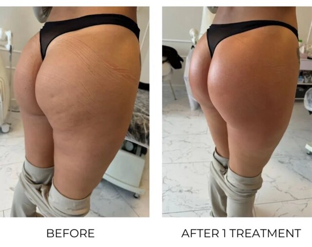 Lower-body before and after T-Shape 2 treatment