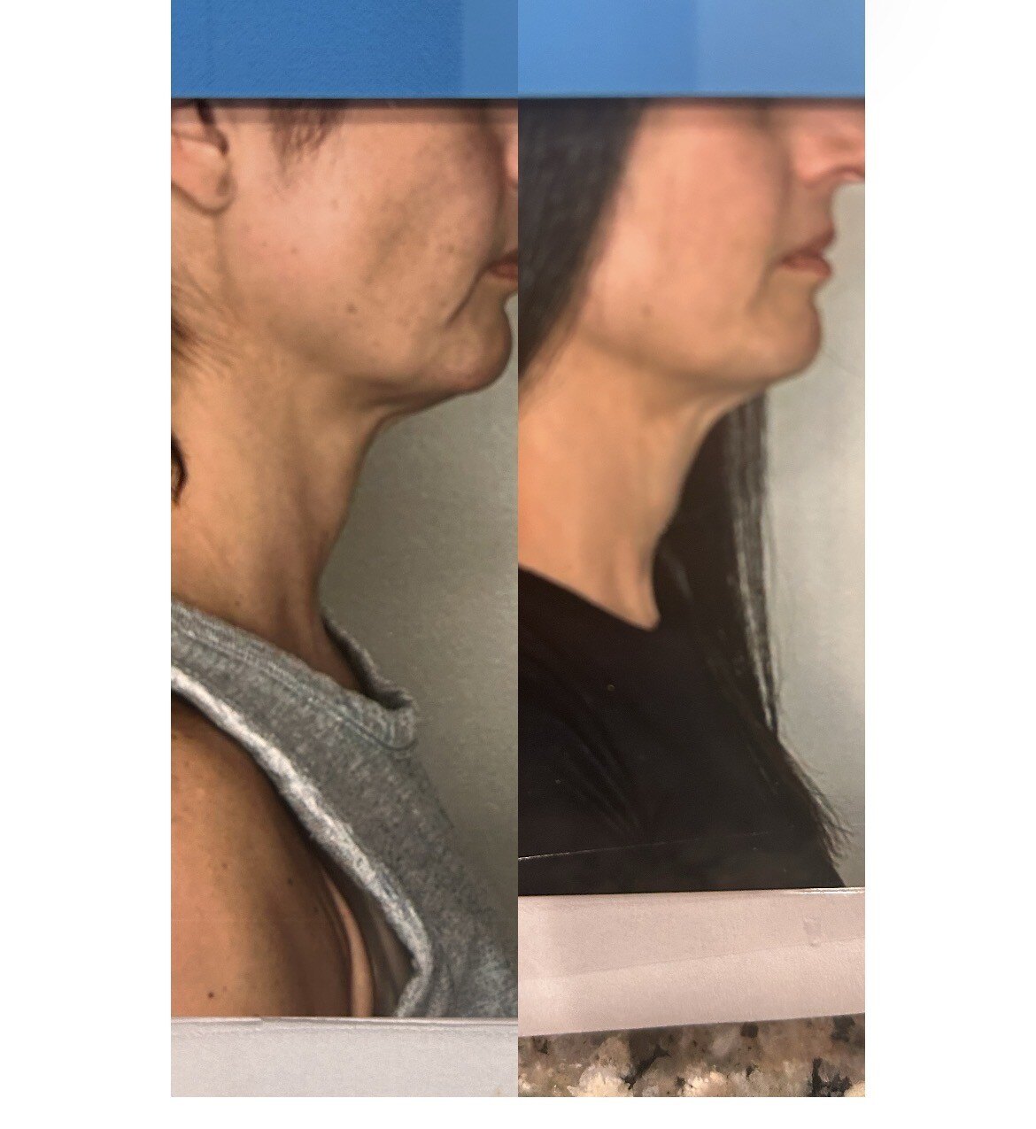 Neck and jawline before and after T-Shape 2 treatment